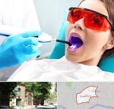 جراحی لثه با لیزر در دزاشیب
