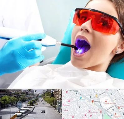 جراحی لثه با لیزر در خیابان زند شیراز