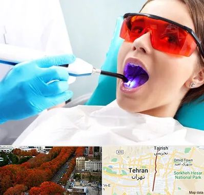 جراحی لثه با لیزر در ولیعصر 