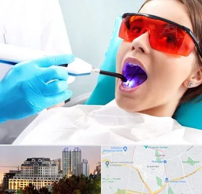 جراحی لثه با لیزر در فرشته 