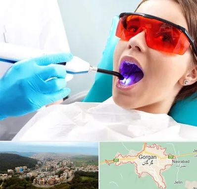 جراحی لثه با لیزر در گرگان