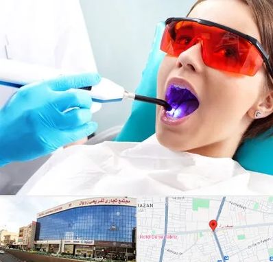 جراحی لثه با لیزر در نصف راه تبریز