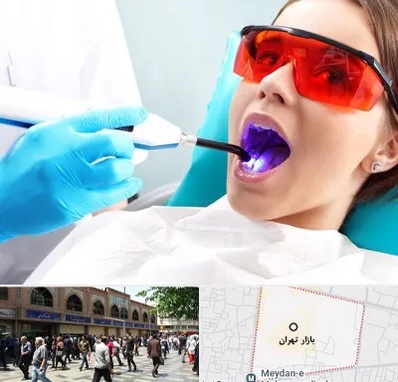 جراحی لثه با لیزر در بازار تهران