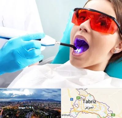 جراحی لثه با لیزر در تبریز