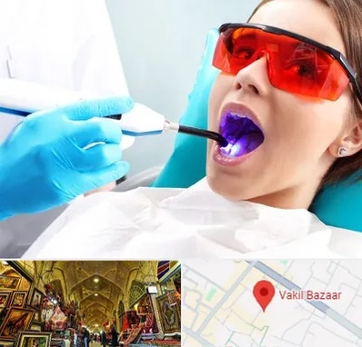 جراحی لثه با لیزر در بازار وکیل شیراز