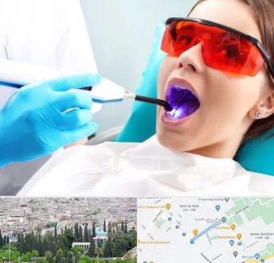 جراحی لثه با لیزر در محلاتی شیراز