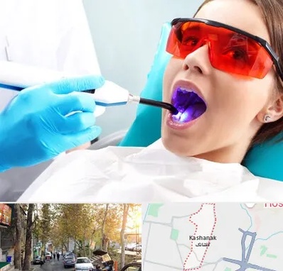 جراحی لثه با لیزر در کاشانک