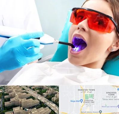 جراحی لثه با لیزر در اکباتان 