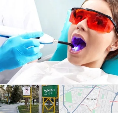 جراحی لثه با لیزر در تهران ویلا
