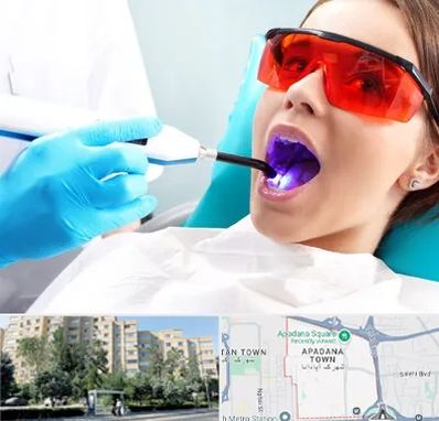 جراحی لثه با لیزر در آپادانا