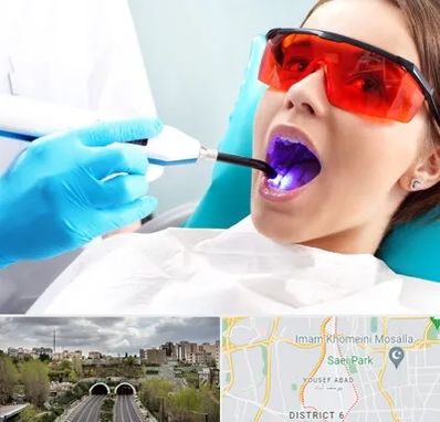 جراحی لثه با لیزر در یوسف آباد 