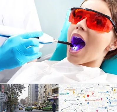 جراحی لثه با لیزر در فاطمی