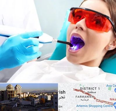 جراحی لثه با لیزر در فرمانیه 