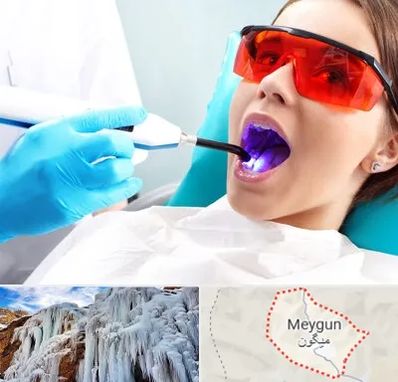 جراحی لثه با لیزر در میگون