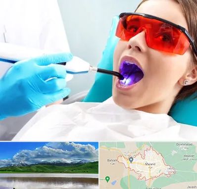 جراحی لثه با لیزر در مرند