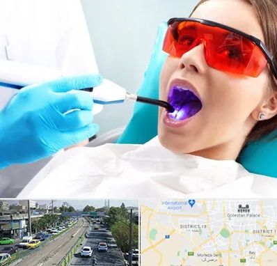 جراحی لثه با لیزر در جنوب تهران 