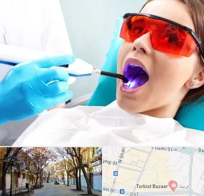 جراحی لثه با لیزر در تربیت تبریز