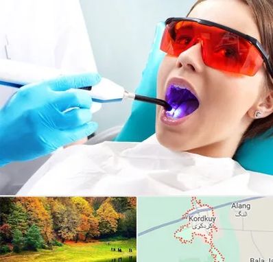 جراحی لثه با لیزر در کردکوی