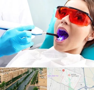 جراحی لثه با لیزر در فاز سه اندیشه
