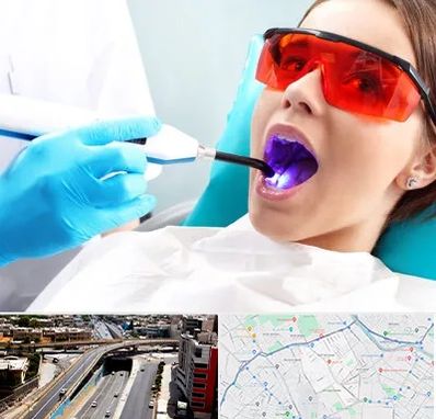 جراحی لثه با لیزر در ستارخان شیراز