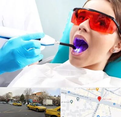 جراحی لثه با لیزر در شهناز تبریز