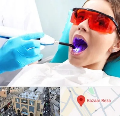 جراحی لثه با لیزر در بازار رضا مشهد