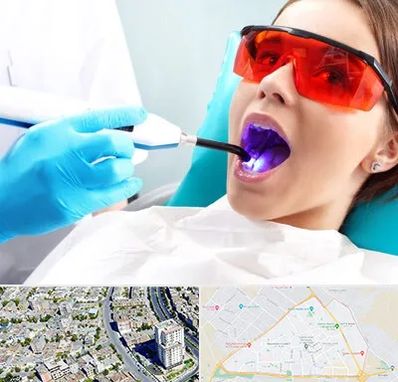 جراحی لثه با لیزر در قاسم آباد مشهد