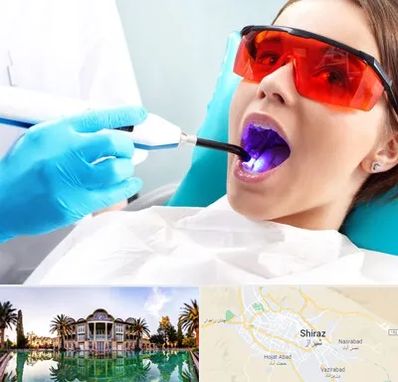 جراحی لثه با لیزر در شیراز
