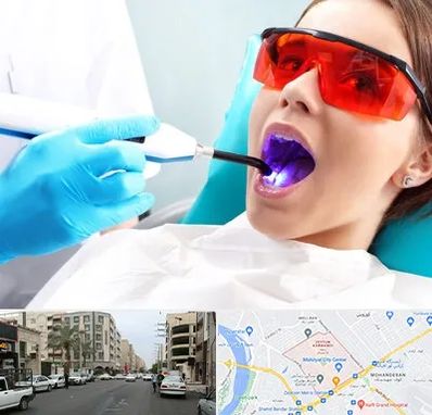 جراحی لثه با لیزر در زیتون کارمندی اهواز
