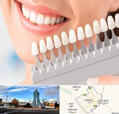 متخصص لمینت دندان در تایباد