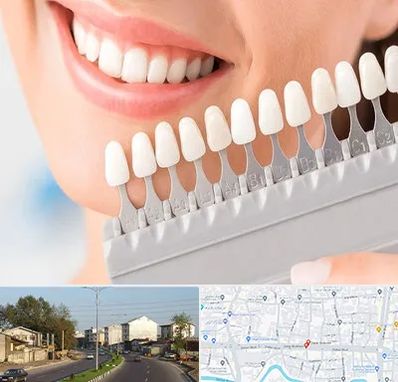 متخصص لمینت دندان در ضیابری رشت