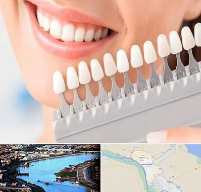 متخصص لمینت دندان در خرمشهر