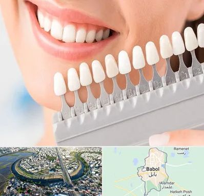 متخصص لمینت دندان در بابل