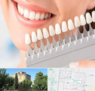 متخصص لمینت دندان در مرداویج اصفهان