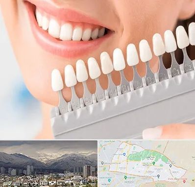 متخصص لمینت دندان در منطقه 4 تهران