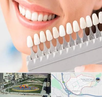 متخصص لمینت دندان در مرزداران تبریز