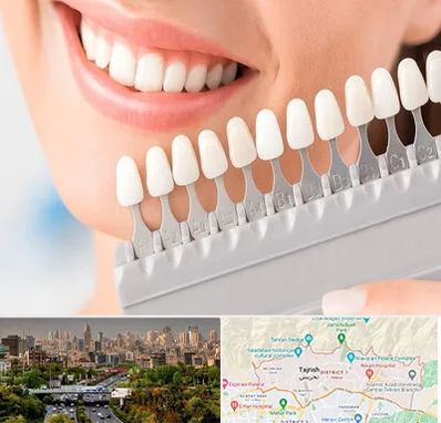 متخصص لمینت دندان در منطقه 1 تهران