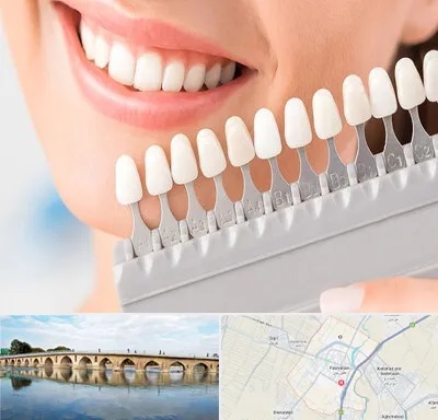 متخصص لمینت دندان در فلاورجان