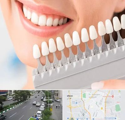 متخصص لمینت دندان در ستارخان 