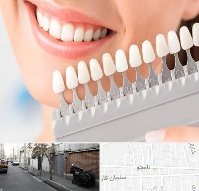 متخصص لمینت دندان در خیابان نامجو