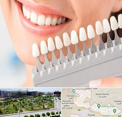 متخصص لمینت دندان در پردیس