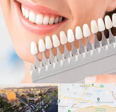 متخصص لمینت دندان در تهرانپارس 