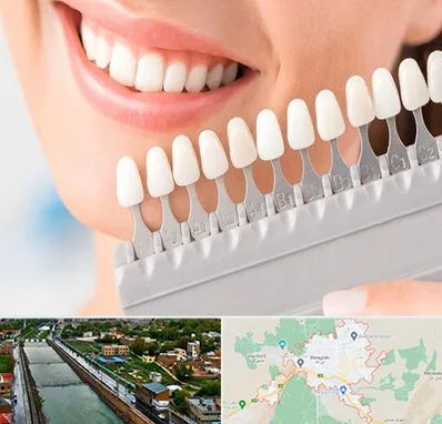 متخصص لمینت دندان در مراغه