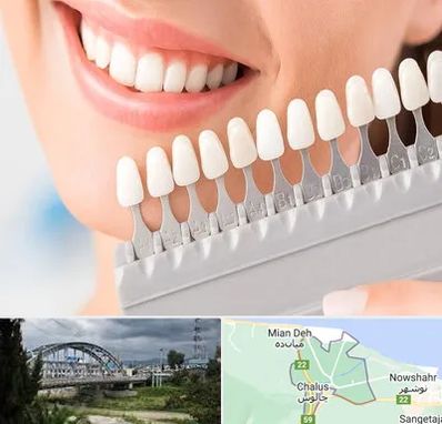 متخصص لمینت دندان در چالوس