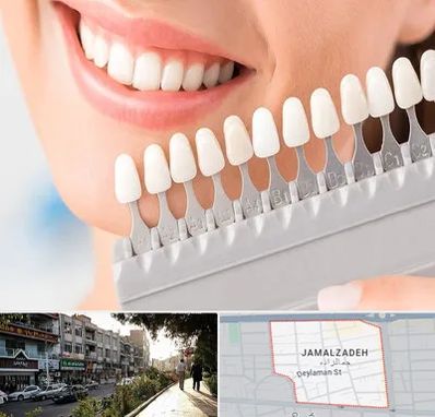 متخصص لمینت دندان در خیابان جمالزاده