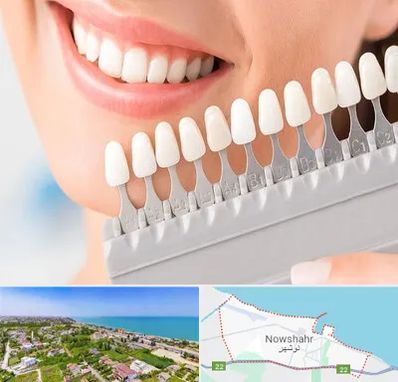 متخصص لمینت دندان در نوشهر