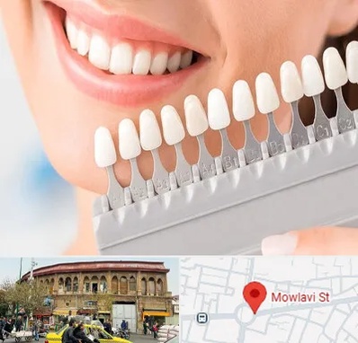 متخصص لمینت دندان در مولوی
