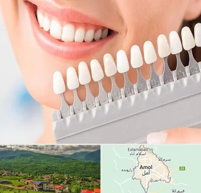 متخصص لمینت دندان در آمل