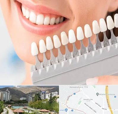 متخصص لمینت دندان در شهر زیبا