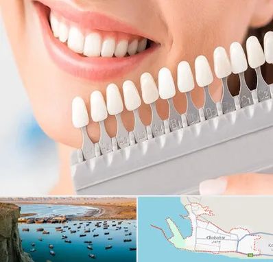 متخصص لمینت دندان در چابهار